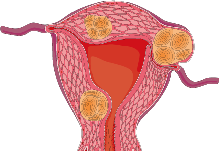 子宮筋腫 子宮内膜症とは 堺市の婦人科 竹山レディースクリニック