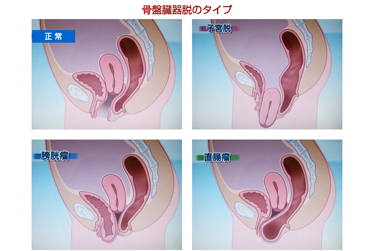 子宮脱 膀胱脱など骨盤臓器脱 大阪府堺市の竹山レディースクリニック